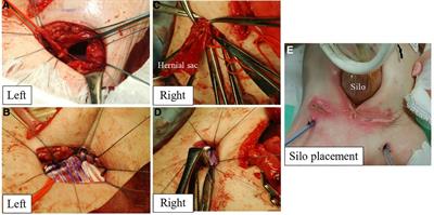 Case report: A giant bilateral inguinal hernia requiring artificial mesh and multi-stage surgery in infancy; hernioplasty with silo placement to prevent acute compartment syndrome